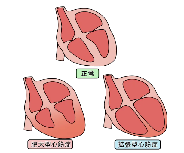 心筋症の種類と原因