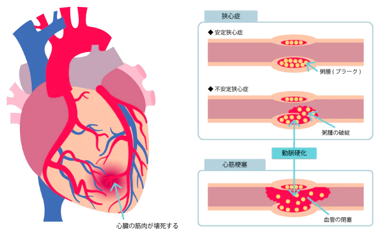 狭心症と心筋梗塞の違い