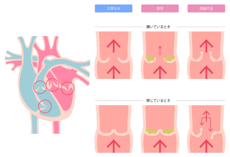 心臓弁膜症とは