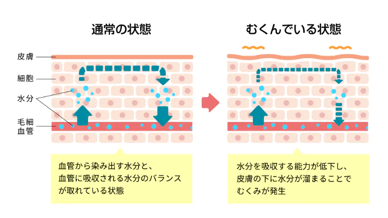 むくみとは