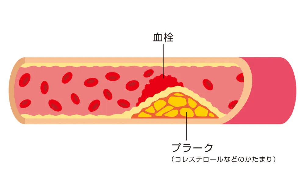 動脈硬化