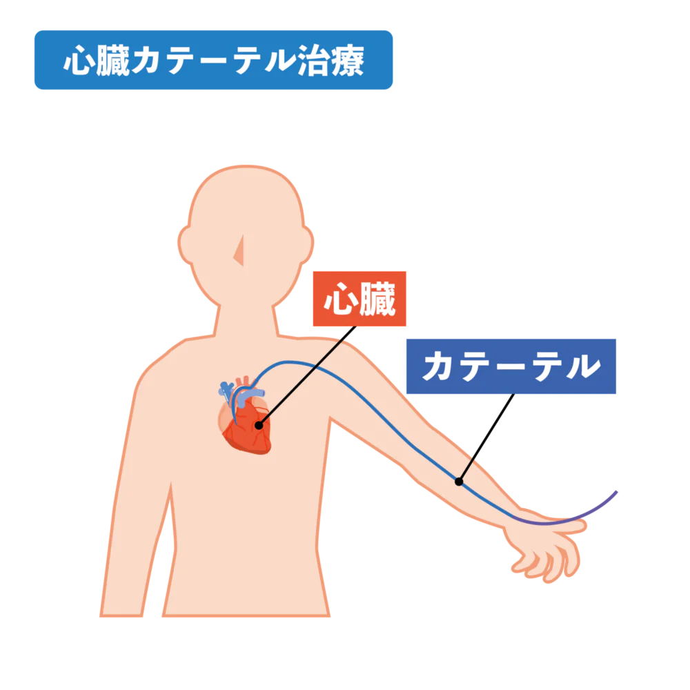 カテーテル治療