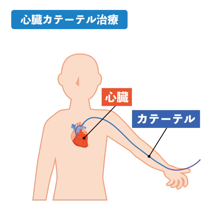 カテーテル治療