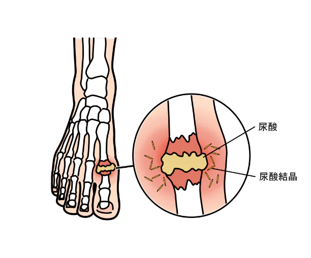 高尿酸血症と痛風との違い